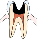 大きい虫歯の場合