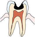 大きい虫歯の場合