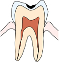 小さい虫歯の場合