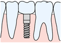インプラント（人工歯根）